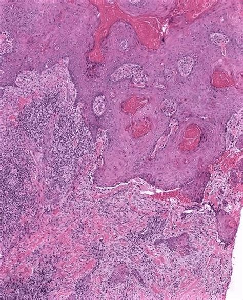 Biopsy Of Hand Plaque With Hematoxylin And Eosin Stain Showing Download Scientific Diagram