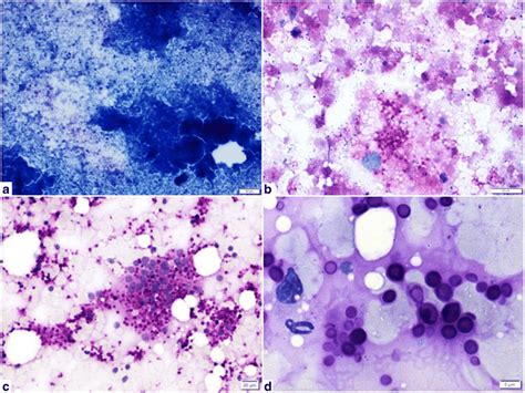 Histoplasmosis A C Aspirate From Adrenal Lesion In A Post Renal Download Scientific Diagram