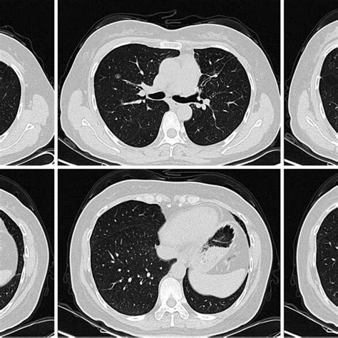 The Postoperative Computed Tomography Scanning After 28 Months Of