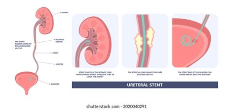 37 Ureterostomy Images Stock Photos And Vectors Shutterstock