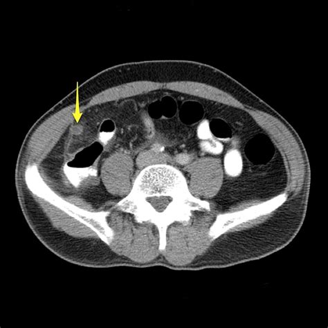 Radiopaedia Appendicitis It May Be Acute Or Chronic