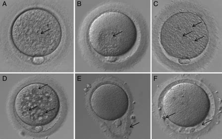 Different Human Oocyte Morphological Abnormalities Arrows Observed By