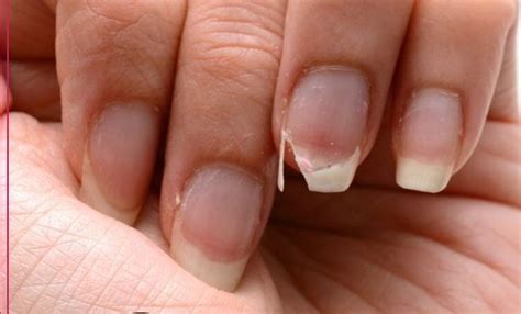 Brittle Nails Causes And Treatments Aleecare