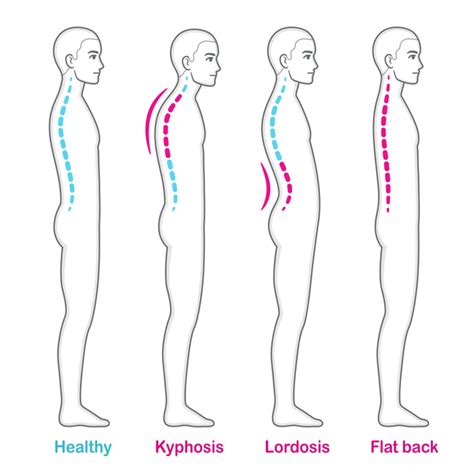 What Is Flatback Syndrome Atlanta Brain And Spine Care