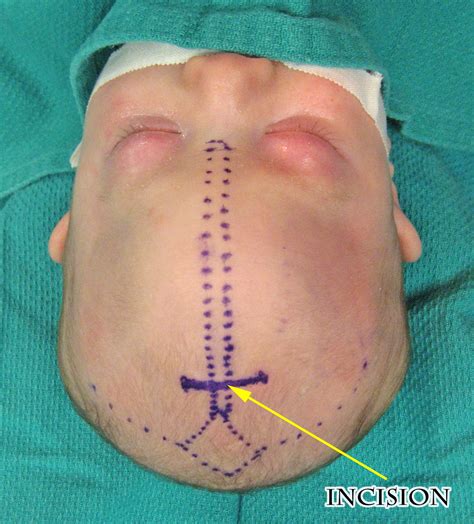 Metopic Synostosis Facts And Photos David F Jimenez Md