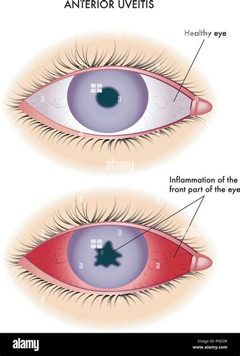 Uveitis Vs Conjunctivitis