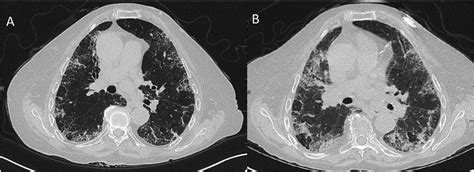 Acute Exacerbation Of Interstitial Lung Disease After Procedures Respiratory Medicine