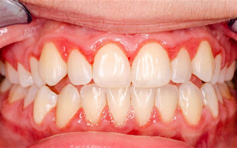 Gingivitis Vs Periodontitis What S The Difference