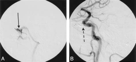 Figure From Cavernous Fistula Case Report And Review Transarterial