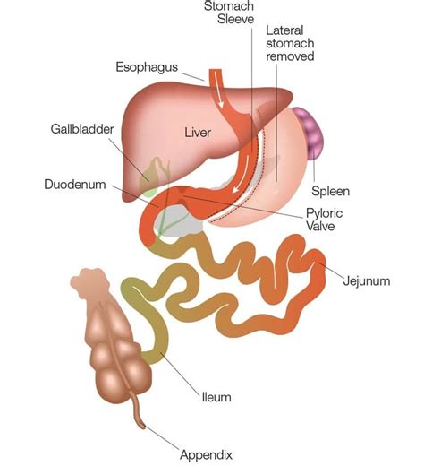 Sleeve Gastrectomy