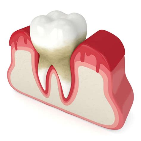 5 Causes Of Periodontal Disease Austin Laser Dentist