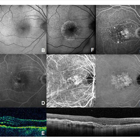 Multimodal Imaging Of Case A Fundus Photography Of The Left Eye