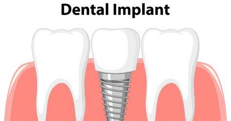 Dental Implant Benefits Costs Procedure Explained Thesoundbar