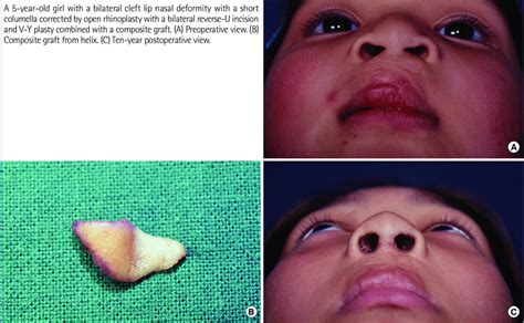 A 5 Year Old Girl With A Bilateral Cleft Lip Nasal Deformity With A Download Scientific Diagram