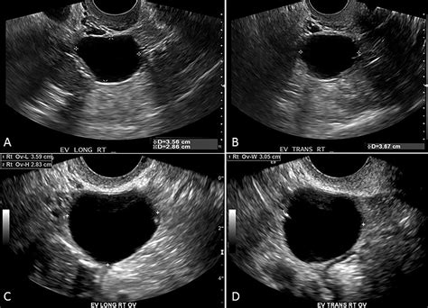 Serous Cystadenoma Ultrasound