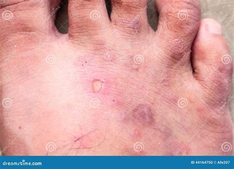 Closeup Skin Athletes Foot Psoriasis Fungus Hong Kong Foot Stock