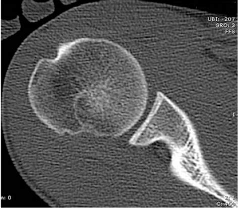 Management Of Humeral Defects In Anterior Shoulder Instability