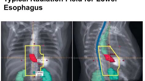 esophagus cancer radiation - YouTube