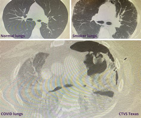 Lung Damage Complications in COVID-19 Survivors