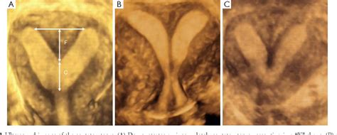 Figure From The Effectiveness Of Uterine Parametrics Measured By