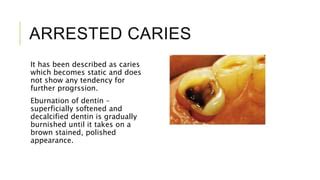 Dental caries | PPT