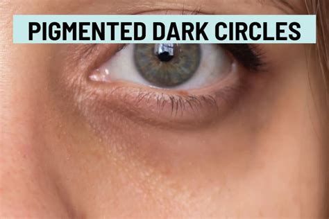 Dark Circles Under The Eyes Causes Types And Treatments