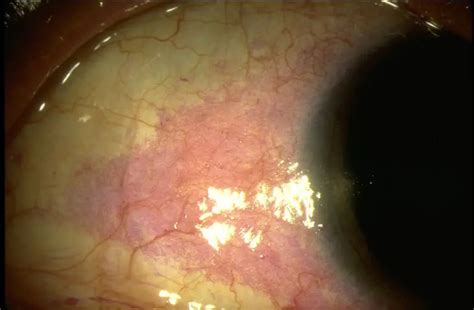 Keratoconjunctivitis sicca - American Academy of Ophthalmology