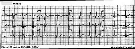 Instructors Collection Ecg Right Bundle Branch Block And More Ecg Guru Instructor Resources