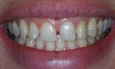 Veneers Vs Crowns Vs Dental Tooth Bonding Cosmetic Dentist Los