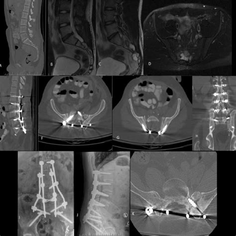 A B Pre Operative Sagittal And Axial Ct Scan Images Demonstrating Download Scientific Diagram