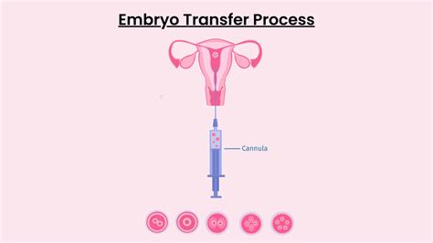 Which Is Better Single Or Multiple Embryo Transfer