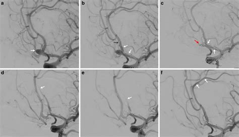 Intraprocedural Thrombus During Endovascular Coil Embolization Of An