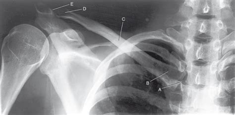 X Ray Anatomy Clavicle Diagram Quizlet