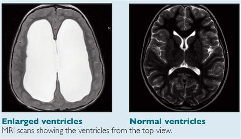 Shunt Systems Hydrocephalus Association