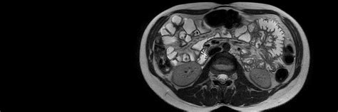 MRI to evaluate small bowel Crohn's disease