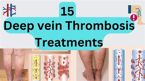 15 Deep Vein Thrombosis Treatments Youtube