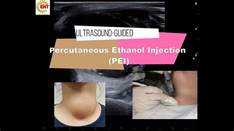 Ultrasound Guided Percutaneous Ethanol Injection Pei Youtube