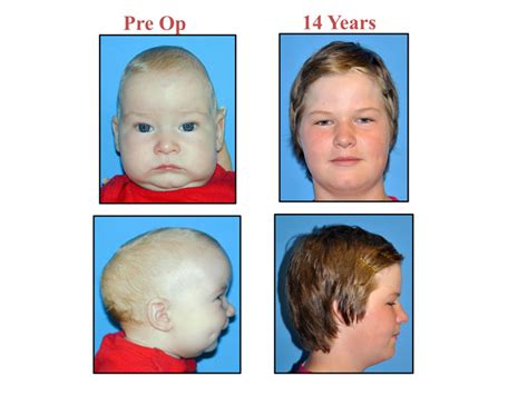 Craniosynostosis