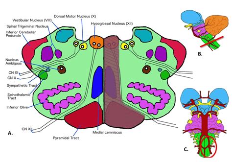 Structures Affected In Medial Medullary Syndrome A Transverse View Of