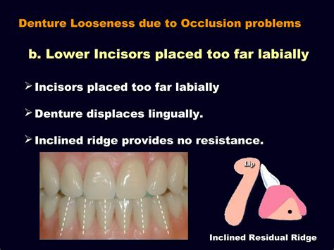 7 Try In Of The Wax Trial Complete Denture Ppt