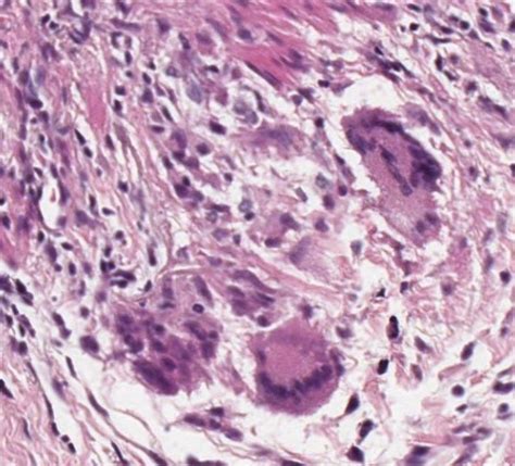 Multinucleated Giant Cells Gca Histology