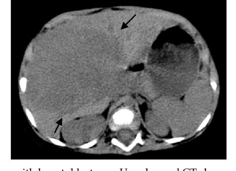 Figure From Ct Scan Of Pediatric Liver Tumors Semantic Scholar