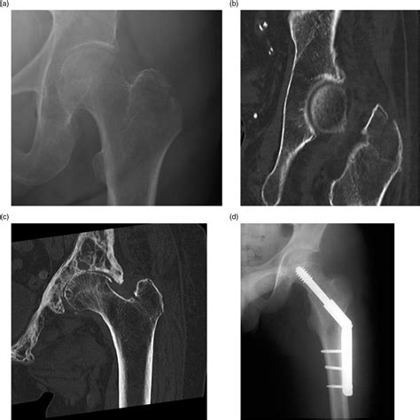 Greater Trochanter Fracture