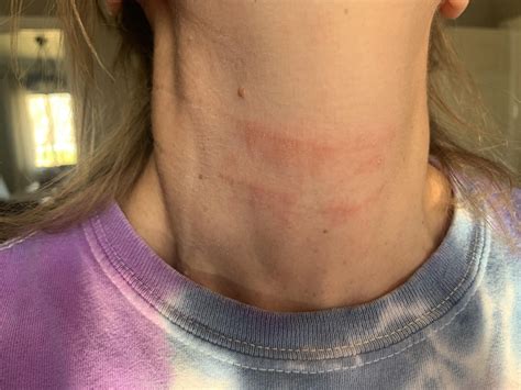 Itchy Rash On Neck