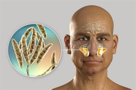 Anatomia Della Rinosinusite E Batteri Che Causano Sinusite