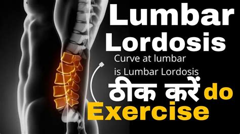 What Is The Fastest Way To Fix Lumbar Lordosisloss Of Lumbar Lordosis