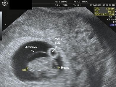 New Charts For Ultrasound Dating Of Pregnancy Telegraph