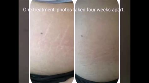 DermaEraze Stretchmarks Scar Treatment Before Afters YouTube