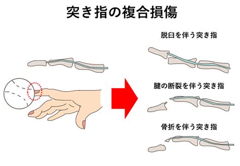 突き指 はっとりはりきゅう接骨院グループ