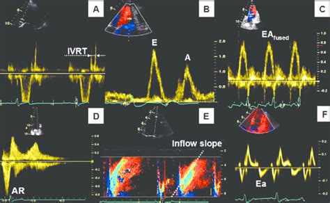 Representative Doppler Echocardiographic Images And Ecg Recordings